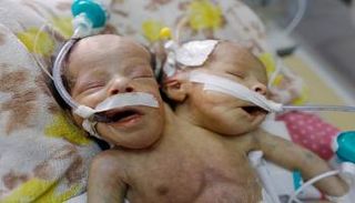 توأم ملتصق في حاجة للعلاج خارج اليمن