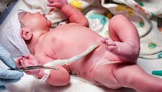 تأخير قطع الحبل السري مفيد للأطفال