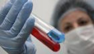 تركيبة دواء جديدة تعالج سرطان الكلى المتقدم