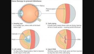 نجاح أول اختبار لمكافحة العمى بالعلاج الجيني