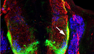 الخلايا العصبية الحركية محاصرة داخل الحبل الشوكي لافتقاد التوجيه