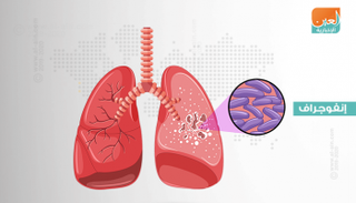 اليوم العالمي للسل 