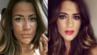 مكياج طبي يخفي البهاق عن الوجه