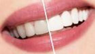 أسباب اصفرار الأسنان وكيفية علاجه وتنظيف الأسنان طبيعيا