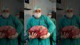 استئصال ورم 16 كيلوجراما من بطن فتاة