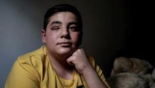 محمد الصبي السوري الذي فقد عينه