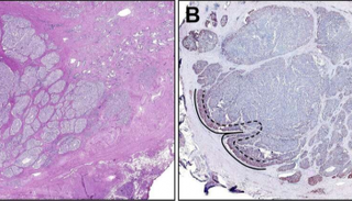 بروتين سينتافيلين في مركز الورم "يسار ا" وفي الحافة الخارجية "يمينا " 
