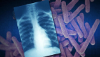 باحثون يحدّدون حالةً وراثيةً تضعِف المناعة أمام ميكروب السلّ