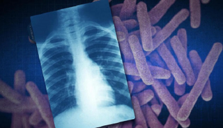 الاكتشاف الجديد يساعد في علاج السلّ.