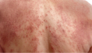 أشعة الشمس تزيد من خطر الإصابة بسرطان "ميلانوما"