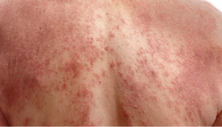 أعراض سرطان "ميلانوما"