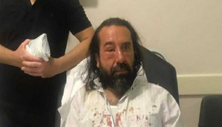 آثار الاعتداء العنيف تبدو على وجه المعارض التركي متين بوزقورط