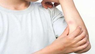 عوامل تجعلك أكثر عرضة للدغات البعوض