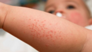 أعراض "حمو النيل" وكيفية الوقاية منه وعلاجه