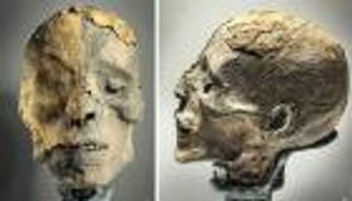 تسجيل أقدم إصابة بورم الغدة النخامية في مومياء مصرية بألمانيا