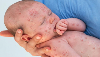 مرض الحصبة ـ أرشيفية