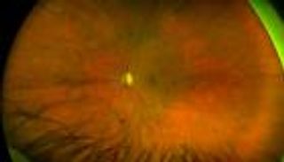 "الريتينول 3".. أمل جديد لعلاج اعتلال الشبكية السكري