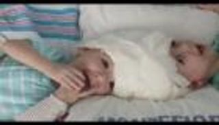 فصل توأمتين ملتصقتين من الرأس في بريطانيا