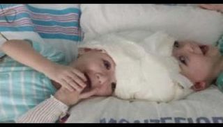 أطباء بريطانيون يعلنون نجاح فصل توأمتين ملتصقتين من الرأس