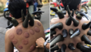 بقرن جاموس.. الحجامة على الطريقة الإندونيسية