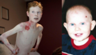 الطفل الفراشة.. مرض وراثي ليس له علاج