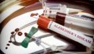 اختبار جديد للدم يكتشف ألزهايمر قبل 20 عاما من ظهوره