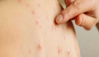 الحصبة شديدة العدوى وتؤدي إلى الوفاة