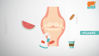 8 نصائح لمرضى النقرس قبل تناول لحوم العيد