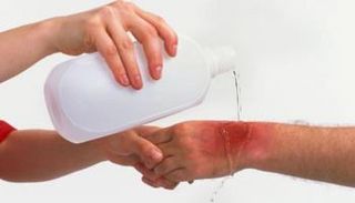 الماء متوسط البرودة لمعالجة حروق الشواء - أرشيفية