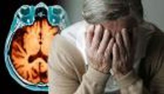 اكتشاف جينات جديدة مسؤولة عن مرض "ألزهايمر"