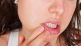 القرحة الفموية.. أعراض تستلزم استشارة الطبيب