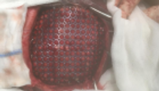 على نفقة الإمارات.. إجراء جراحة "ترقيع جمجمة" بالقاهرة لمصاب يمني