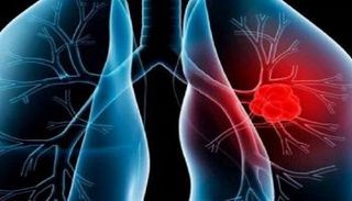 استهداف أحد البروتينات يساعد على علاج ارتفاع ضغط الدم الشرياني الرئوي