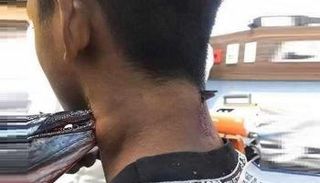 سمكة إبرة تخترق عنق إندونيسي - أرشيفية