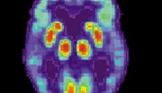 مسح لدماغ بشري مصاب بمرض الزهايمر