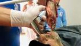 استخراج سمكة حية من القصبة الهوائية لصياد مصري.. كيف ابتلعها؟ 