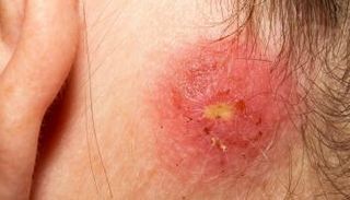 أحد أشكال الإصابة بمرض مارسا