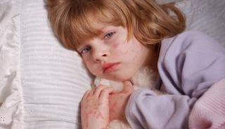 أعراض الداء الخامس تتمثل في طفح جلدي باللون الأحمر