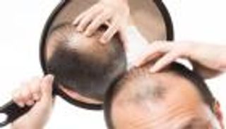 علاج الصلع.. حل سحري من الطبيعة