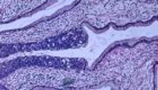 لقاح فيروس الورم الحليمي يقي من سرطان عنق الرحم