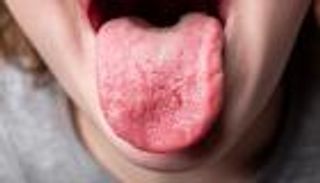 تشقق اللسان.. أسبابه وعلاجه