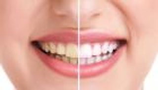 كيفية التخلص من البقع البنية على الأسنان بوصفات طبيعية؟