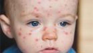 مرض الجدري.. أسبابه وأعراضه وطرق الوقاية