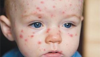 مرض الجدري .. أسبابه وأعراضه وطرق الوقاية