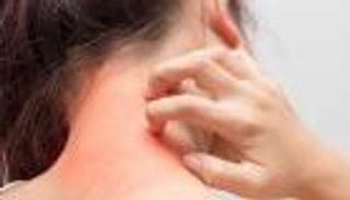 التهاب الجلد التماسي.. الأعراض والأسباب وطرق الوقاية والعلاج