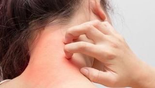 الحكة الشديدة بالجلد من أعراض التهاب الجلد التماسي 