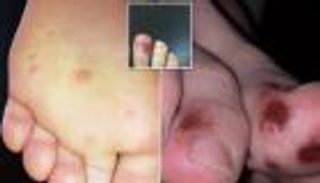 أعراض جديدة لفيروس كورونا 