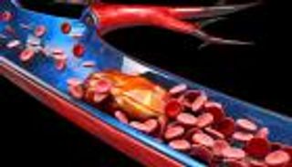 ما هي الجلطات الدموية وأنواعها وأسبابها وكيفية العلاج؟