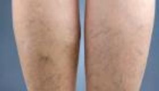 الدوالي.. الأعراض والأنواع والعلاج