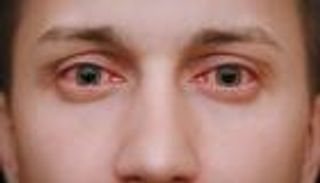 التهاب الملتحمة يهددك بالعمى.. أعراضه وطريقة علاجه